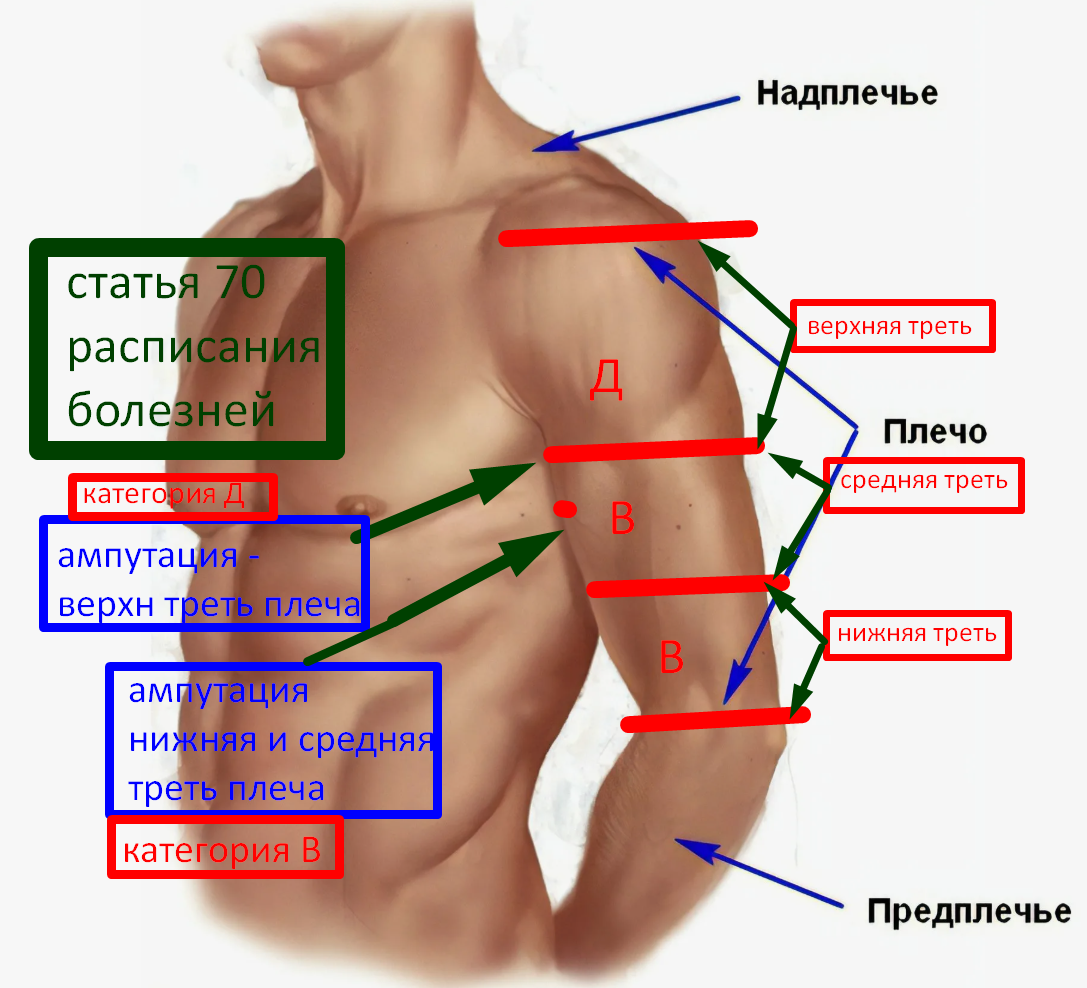 Ампутация руки - категория В - ст расписания болезней 70 